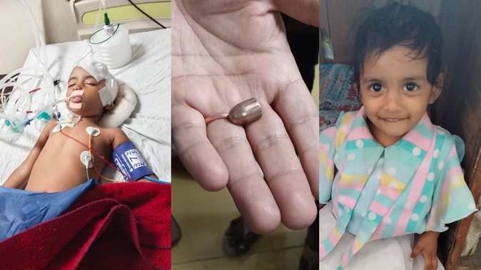 UP: छत पर खेल रही बच्ची के सिर में लगी गोली…मामूली चोट समझ डॉक्टर ने लगाए टांके; ऐसे हुआ चौंकाने वाला खुलासा